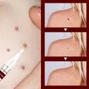 12 Hours Wart Remover Pen Skin Tag Mole Remover Eliminate Foot Corn Warts (Buy 1 Get 1 Free)